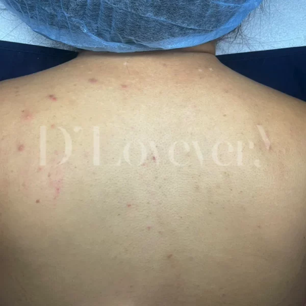 ทำไมต้องทำ รักษาสิว รอยสิวที่หลัง ที่ D’ Lovevery Clinic