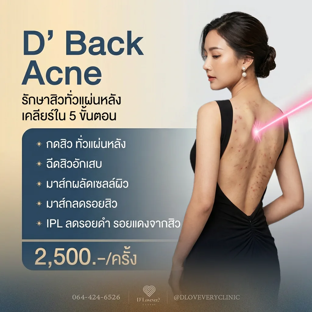 D' Back Acne สิวที่หลัง ต้องรักษาอย่างไร กี่ครั้งถึงจะหาย ราคาเท่าไหร่ คำถามที่พบบ่อย