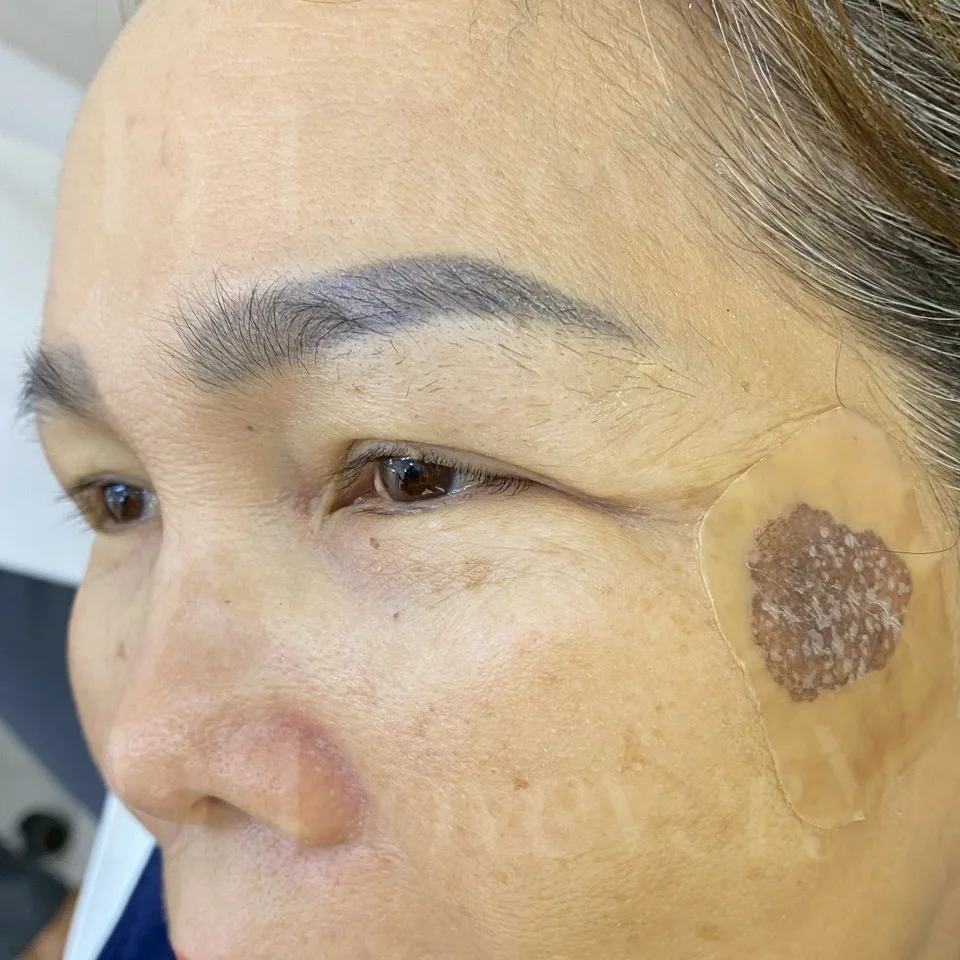 ลอกฝ้า ลอกกระ คืออะไร ใช้อะไรลอก หายจริงไหม