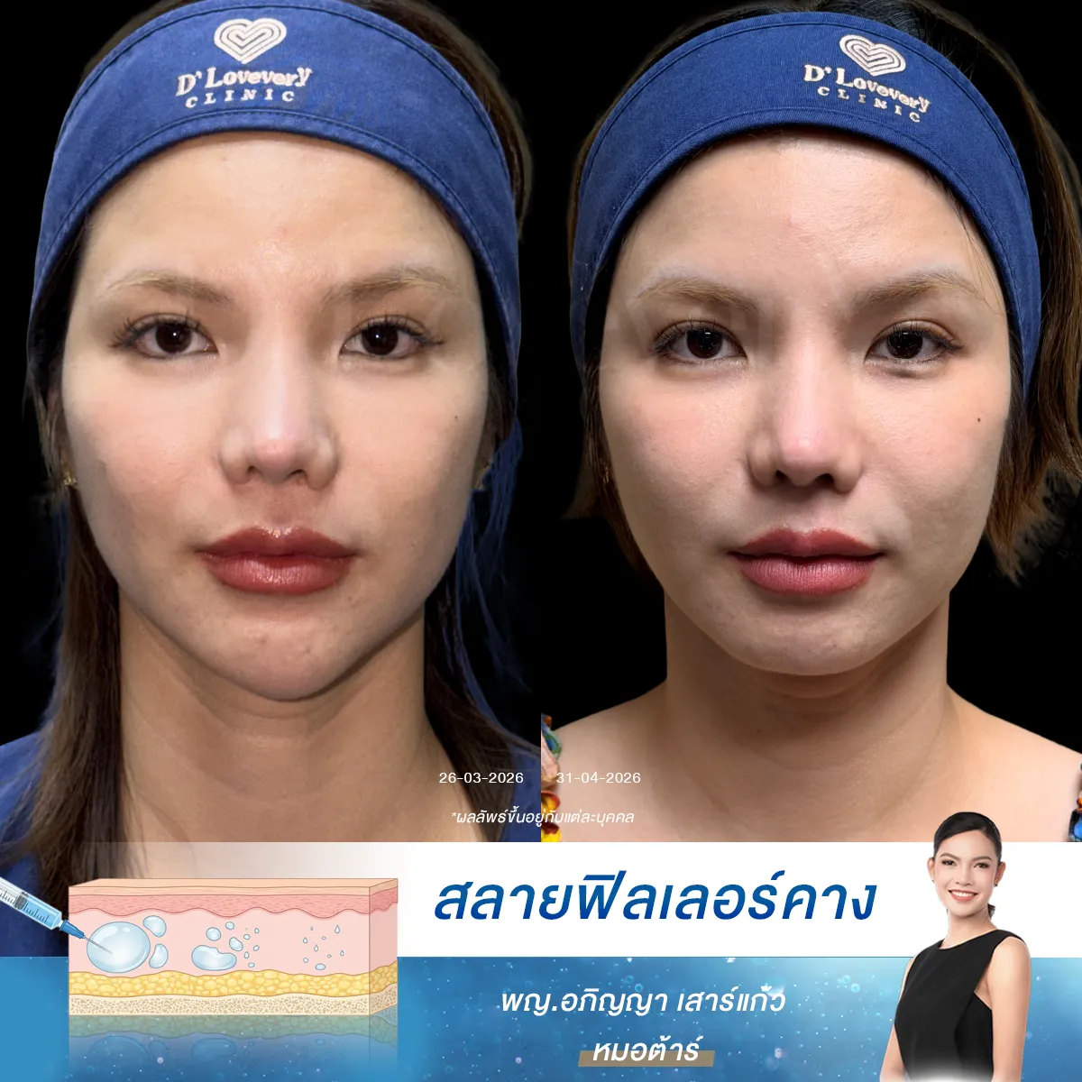 รีวิวสลายฟิลเลอร์คางครั้งแรก มีทดสอบการแพ้ก่อนทำ ปลื้มเลย ปลอดภัยหายห่วงที่ D’ Lovevery Clinic!