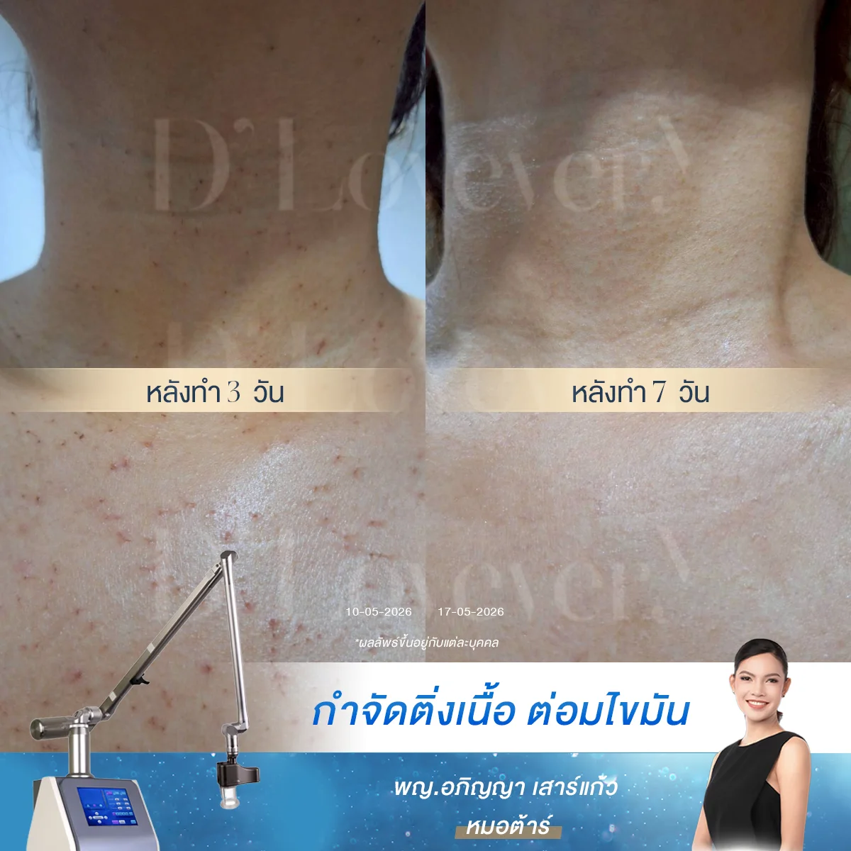 รีวิวโปรจี้ติ่งเนื้อราคาเหมาที่จริงใจ คอ+เนินอก 8000 บาท ผ่าน 1 อาทิตย์ได้ผิวใหม่เนียนๆ