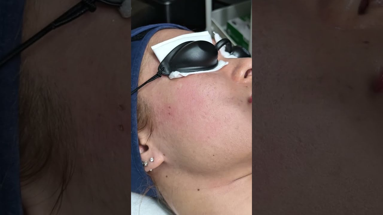 CO2 laser กำจัดขี้แมลงวัน