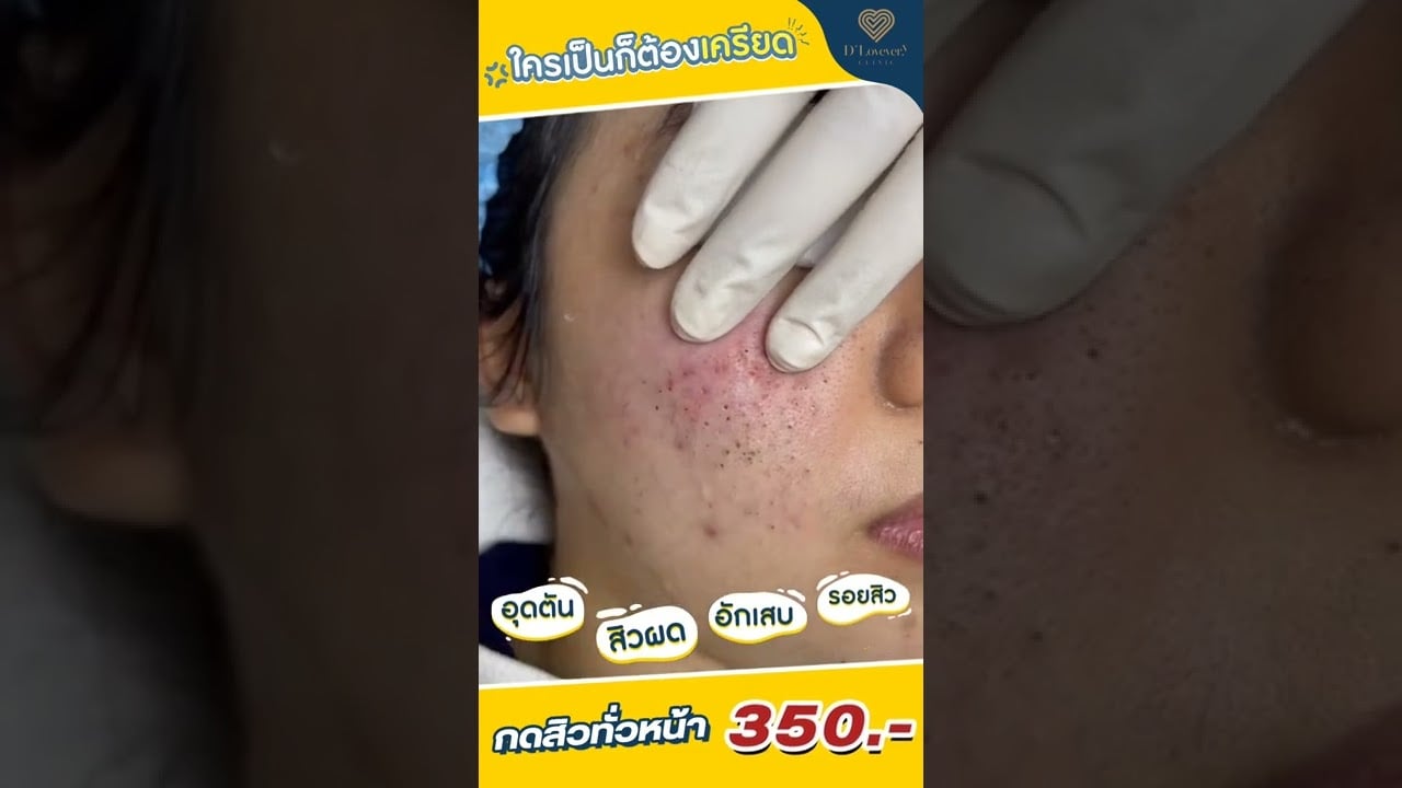 คลิปกดสิว อย่าดูเพลิน ใครอยากกดสิวแบบเหมาทั่วหน้า เพียง 350.-