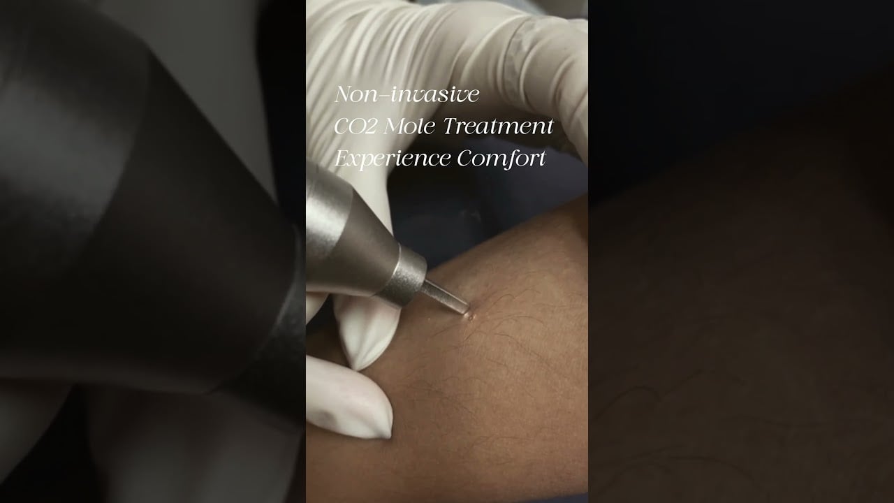 Non-invasive CO2 Mole Treatment - Experience Comfort#จี้ไฝ #ขี้แมลงวัน #กระเนื้อ เหมาๆ หน้าคอ
