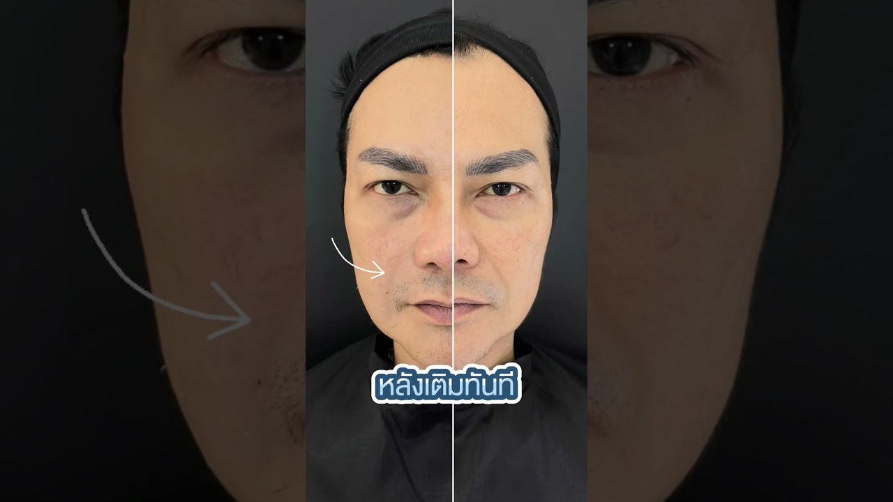 รีวิวเติมฟิลเลอร์ร่องแก้ม ลดอายุ เห็นผลทันที หลังทำ ทายอายุไม่ถูกเลยว่าอายุเท่าไหร่ #หมอต้าร์
