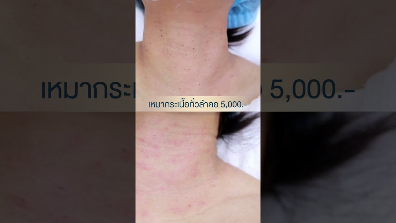 เหมากระเนื้อทั่วลำคอ ราคา 5000.- คลินิกรับกำจัดกระเนื้อ ไฝ ขี้แมลงวัน 2 สาขา