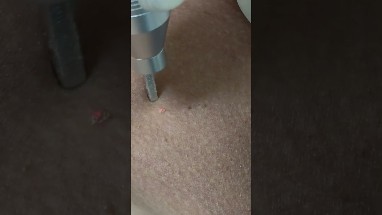 Skin tags กำจัดกระเนื้อด้วย CO2 LASER ปลอดภัย หายเกลี้ยงไม่ทิ้งรอยแผลเป็น ดีเลิฟเวอรี่คลินิก