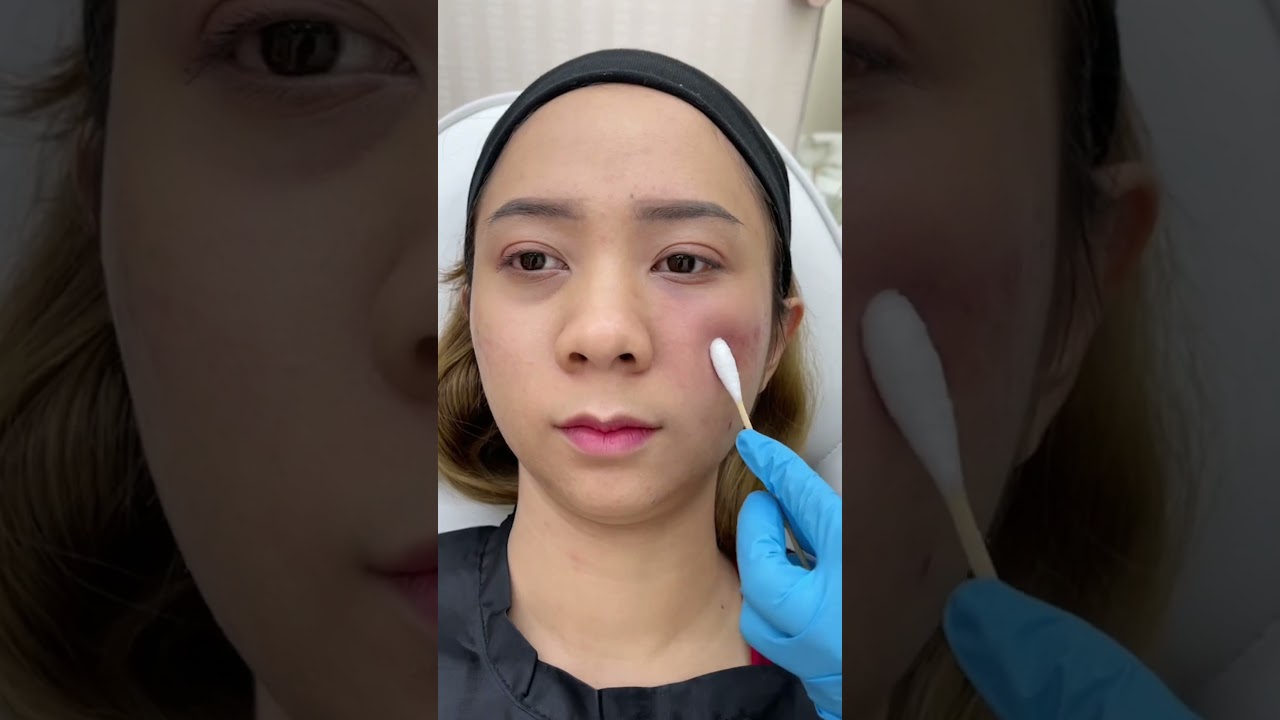 ฟิลเลอร์ใต้ตา รีวิวหลังทำทันที เทียบข้างต่อข้าง 1cc ช่วยได้ สำหรับคนใต้ตาคล้ำ ลึก