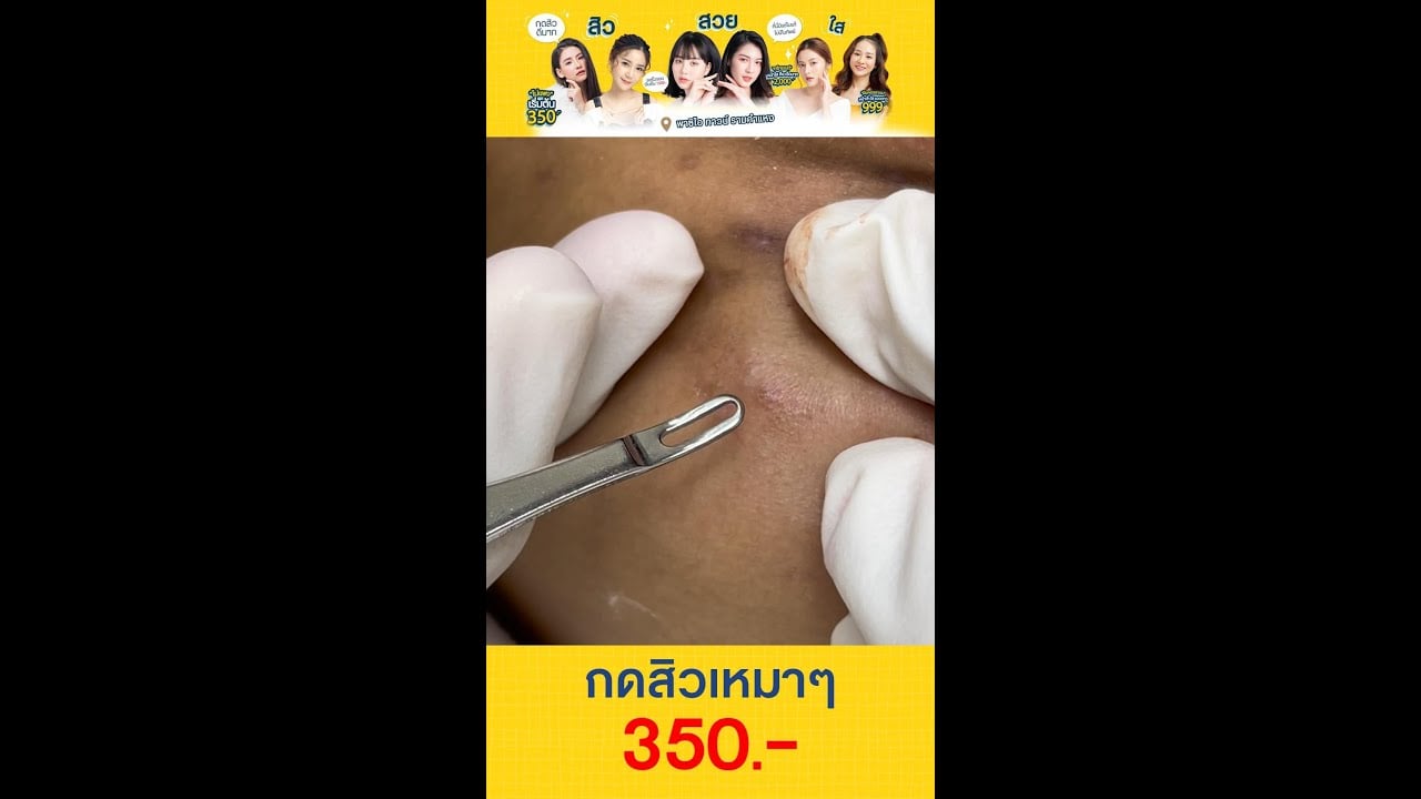 คลิปกดสิว ดูเพลิน คลินิกรักษาสิวย่านรามคำแหง #พาซิโอรามคำแหง เหมาทั่วหน้า 350 บาท กดดี รีวิวเพียบ