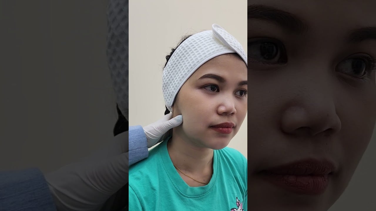 วิธีเช็คกราม กล้ามเนื้อกรามใหญ่ ทำให้หน้าดูกลม ไม่เรียว ก่อนฉีดโบท็อกซ์ลดกราม ต้องเช็คทุกเคส