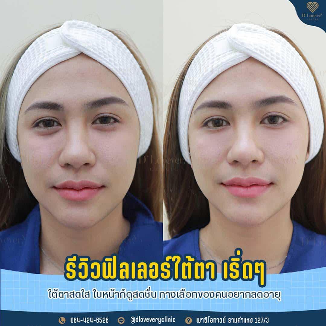 D Lovevery Clinic ดีเลิฟเวอรี่คลินิก โบท็อกซ์ ฟิลเลอร์ เลเซอร์ รักษาสิว กำจัดขน ดริปผิวขาวใส 113
