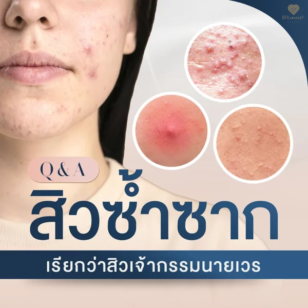 สิวเกิดที่เดิมซ้ำๆ