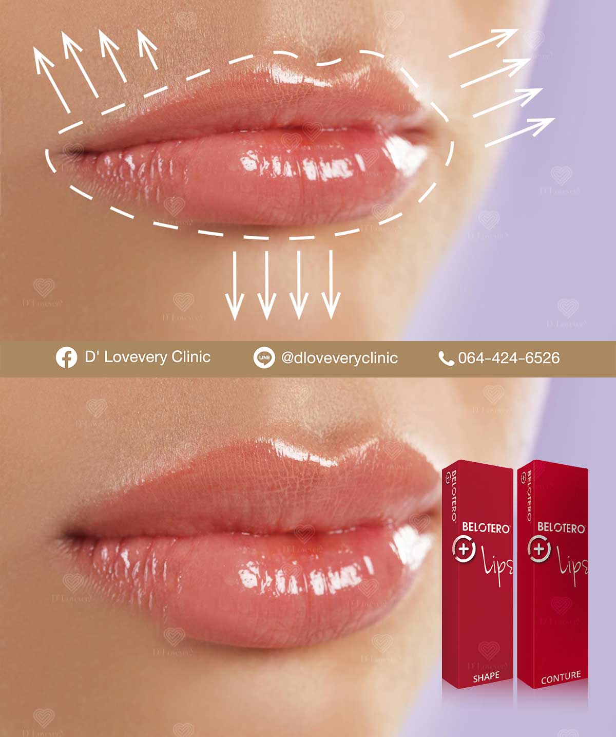 รีวิวฟิลเลอร์ปาก belotero lips