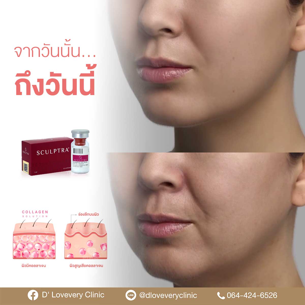 Sculptra before-and-after: reduced nasolabial folds, fuller midface.