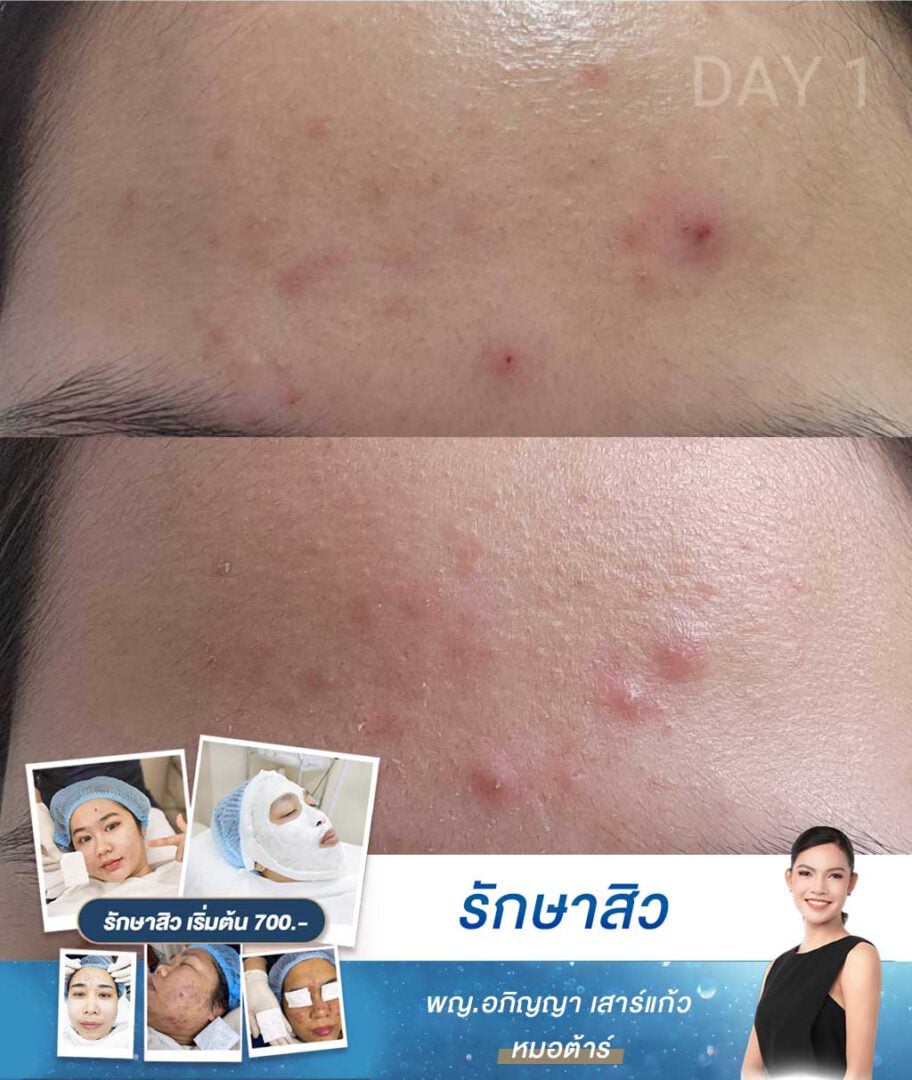 รีวิวรักษาสิว-หน้าผาก-หมอต้าร์-รักษาสิว-รามคำแหง-บางกะปิ-เสรีไทย-1