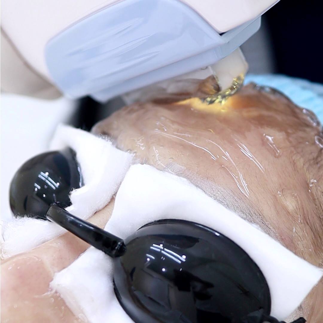 IPL forehead treatment for acne scars and dark spots