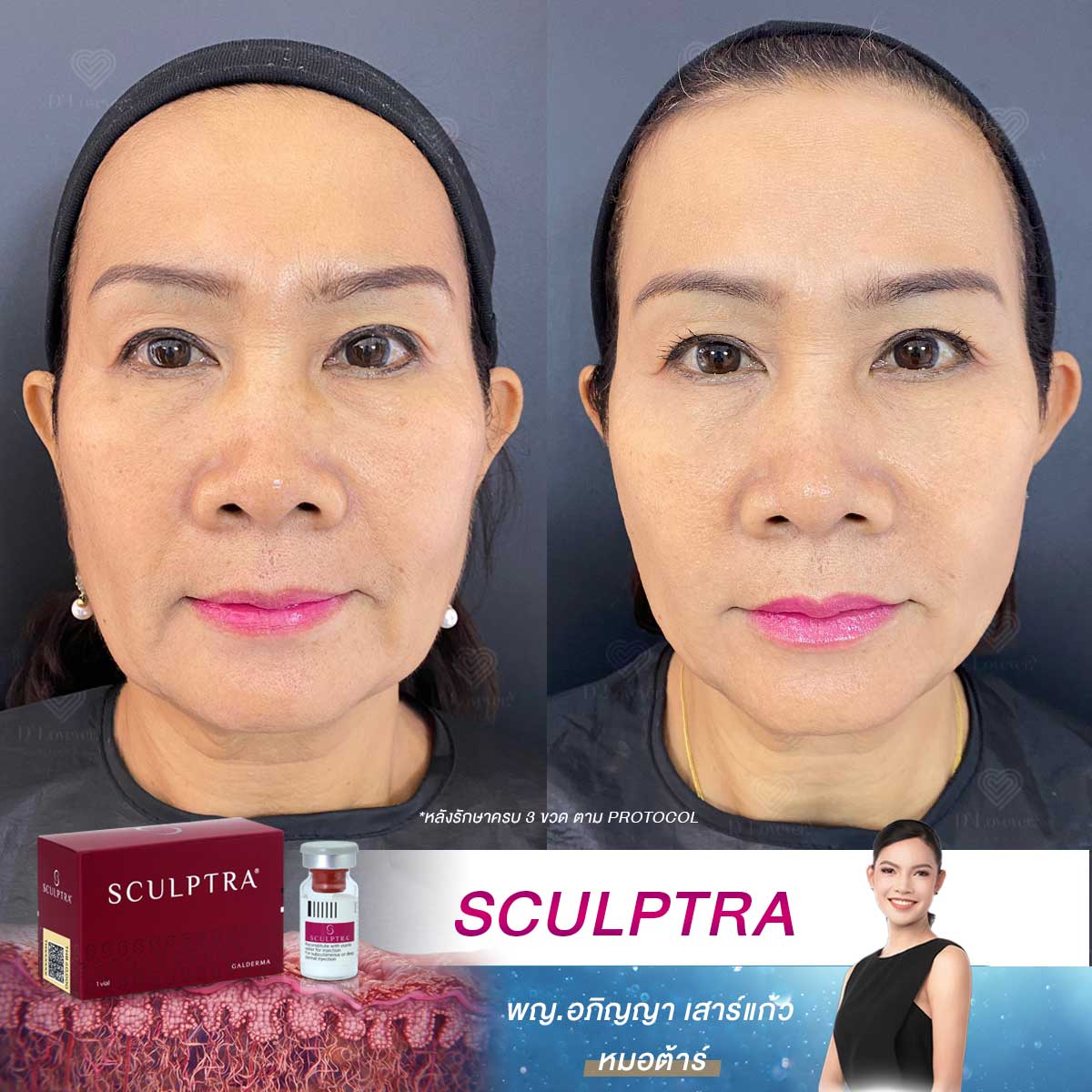 sculptra ก่อนทำ หลังทำ