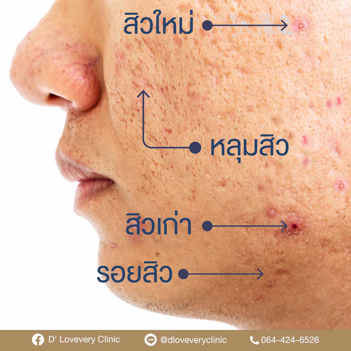 Inflammatory acne with pustules and pitted cheek scars, annotated clinic photo.