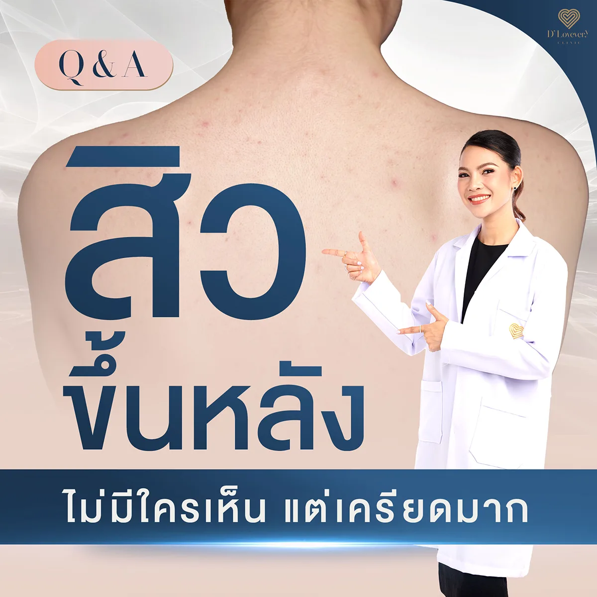 สิวที่หลังเกิดจากอะไร รักษายังไง ราคาเท่าไหร่