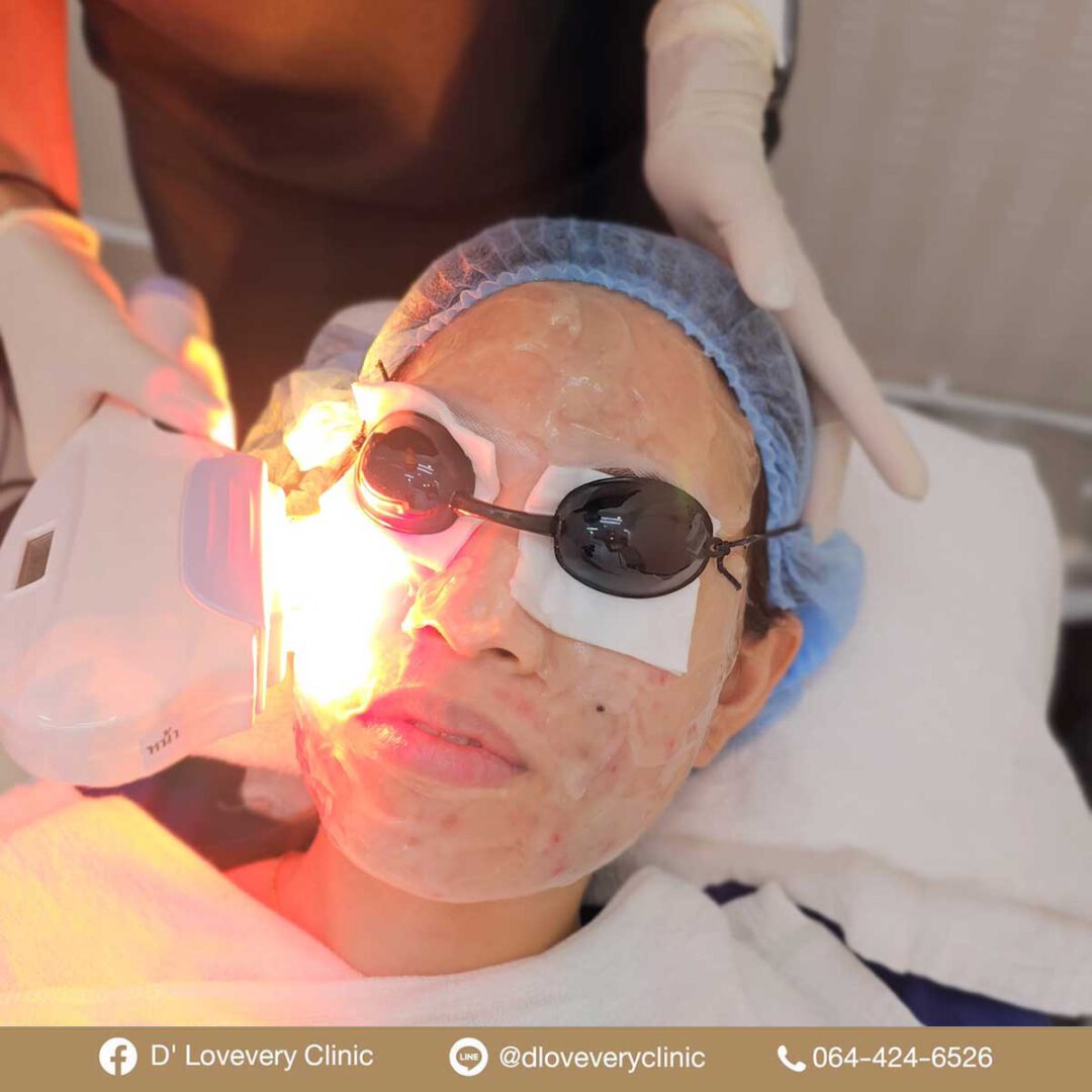 Patient receiving IPL acne scar treatment with protective goggles in clinic