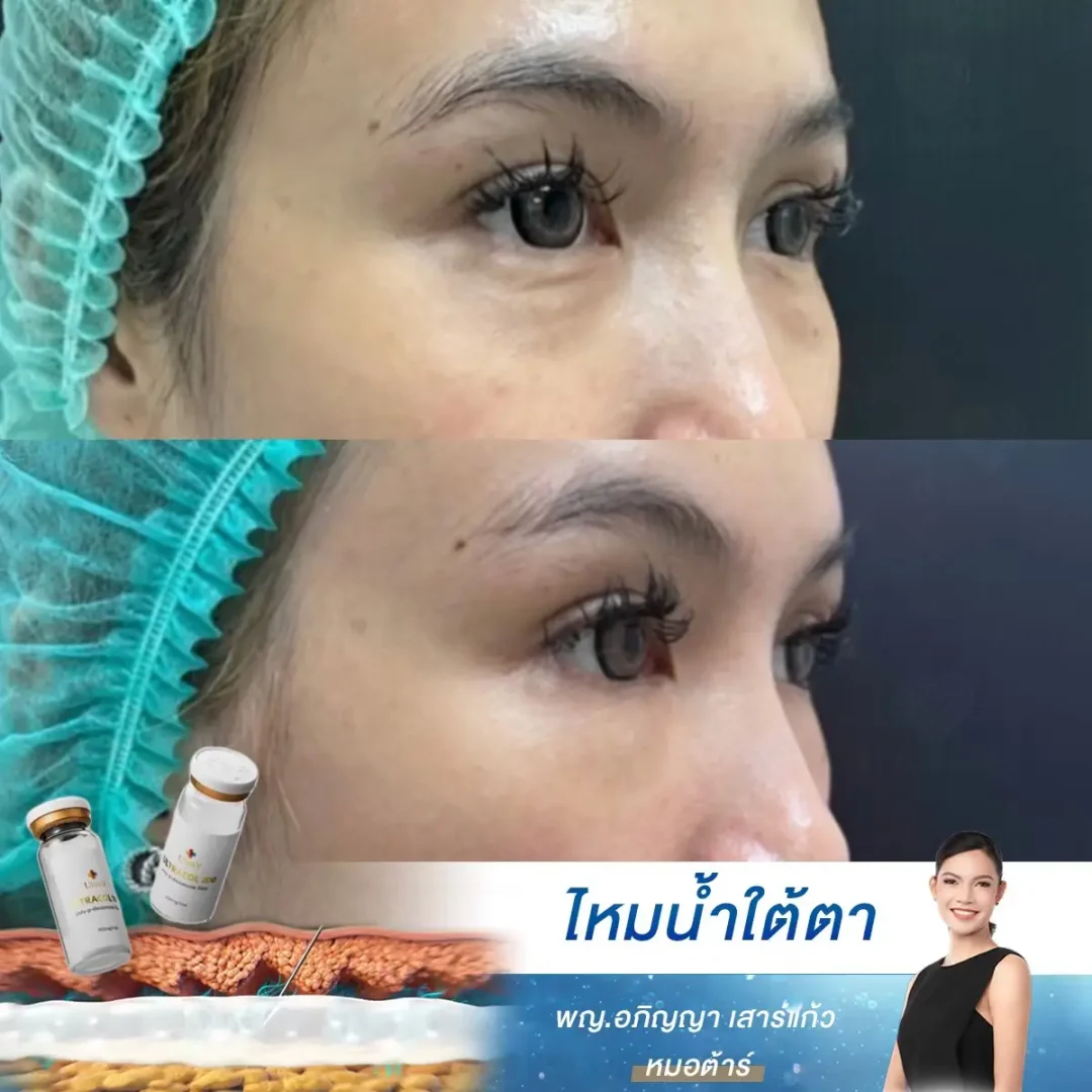 Ultracol Under Eye Treatment Before After