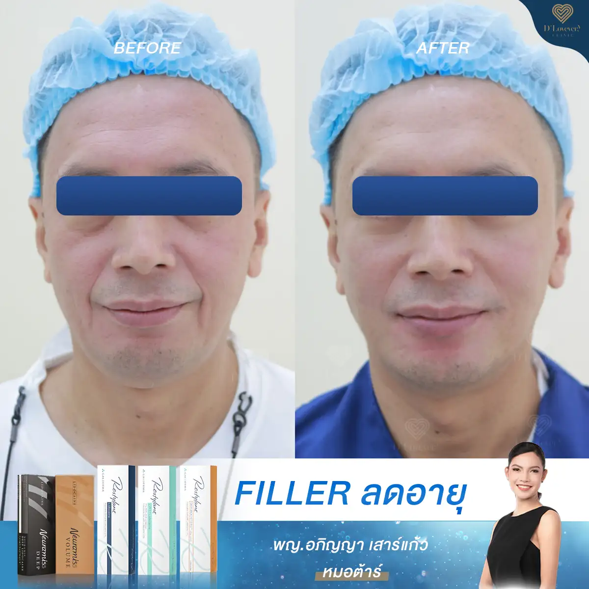ฉีดฟิลเลอร์ใต้ตา รีวิว