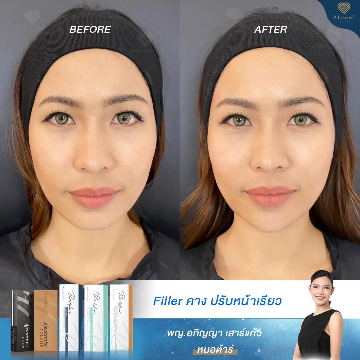 Chin filler 1cc before and after clinic photos: subtle chin refinement, sharper jawline.