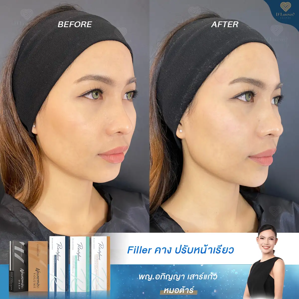 Chin filler 1cc before-and-after, subtle chin projection and smoother jawline