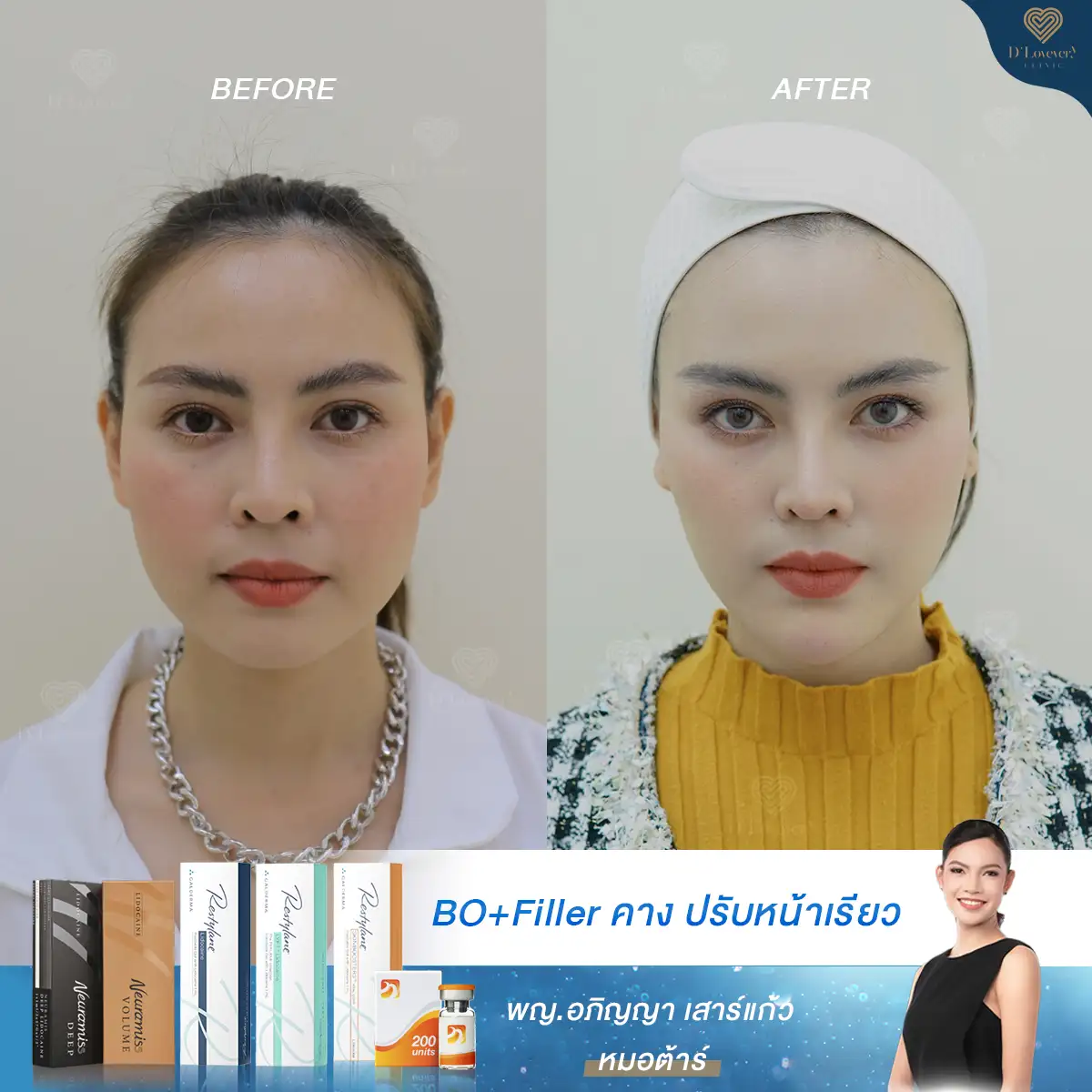 Miss Ploy Before After Chin Filler 1cc