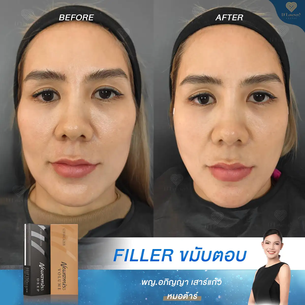 Sunken Temples Corrected Temple Filler Before After