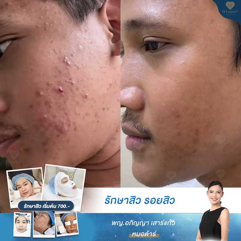 Acne before-and-after: inflamed cheek with papules to clearer skin showing reduced inflammation and scarring