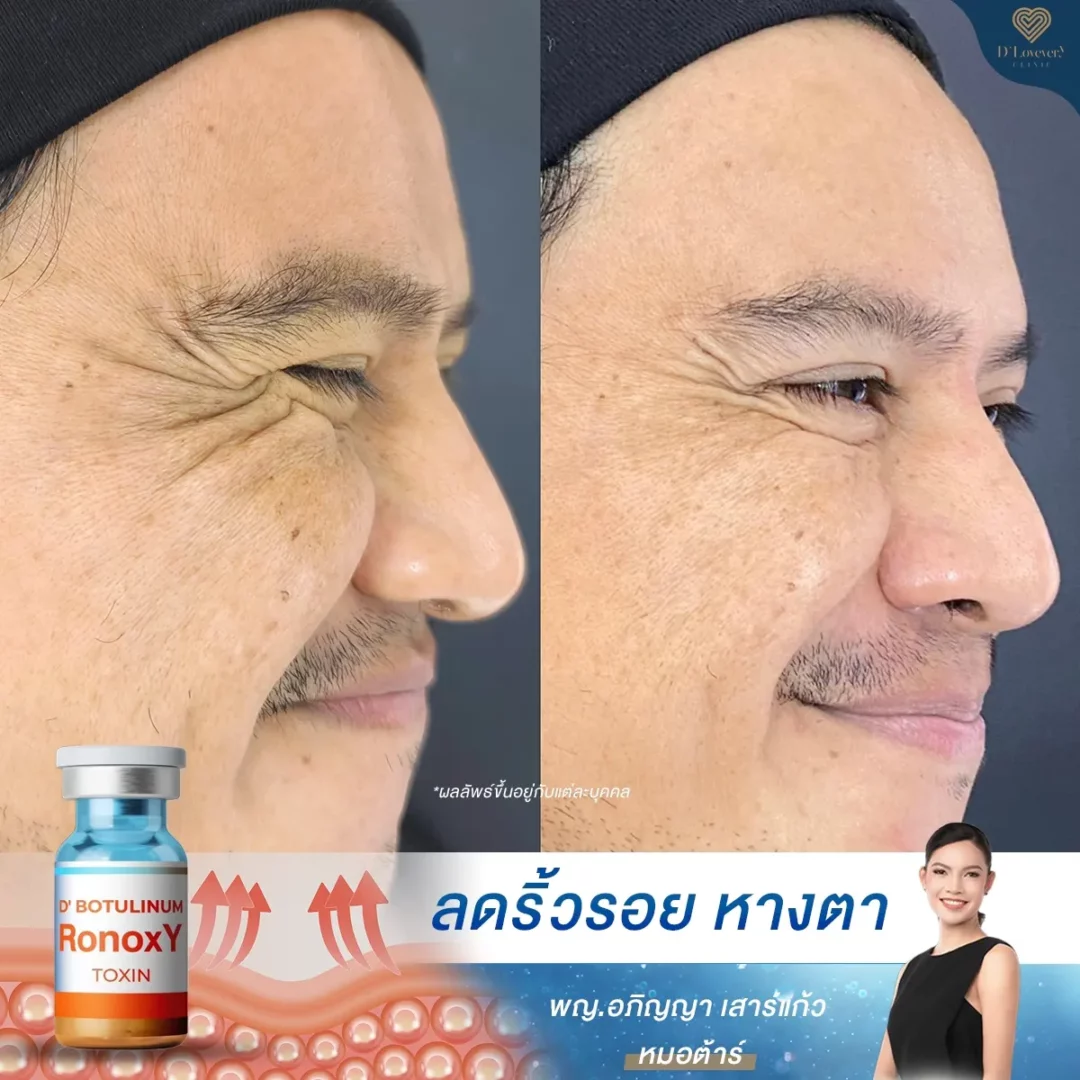 รีวิวโบท็อกซ์ริ้วรอย ตีนกา 3
