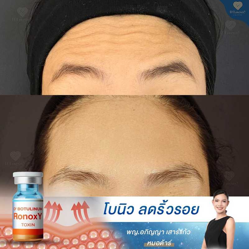 โบท็อกซ์ หน้าผาก