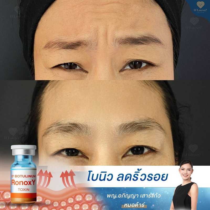 Forehead Botox before-and-after showing reduced frown and glabellar wrinkles
