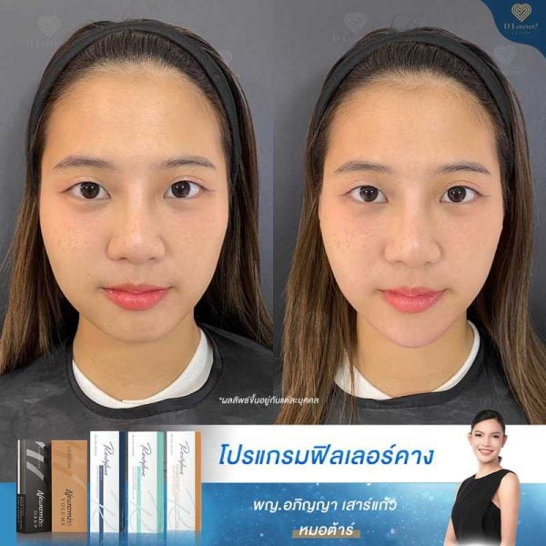 รีวิวฟิลเลอร์คาง 1cc