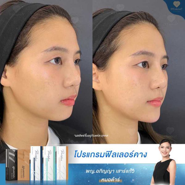 รีวิวฟิลเลอร์คาง