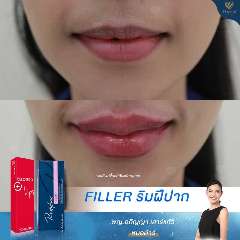 Cute Lip Filler Before After Clinic