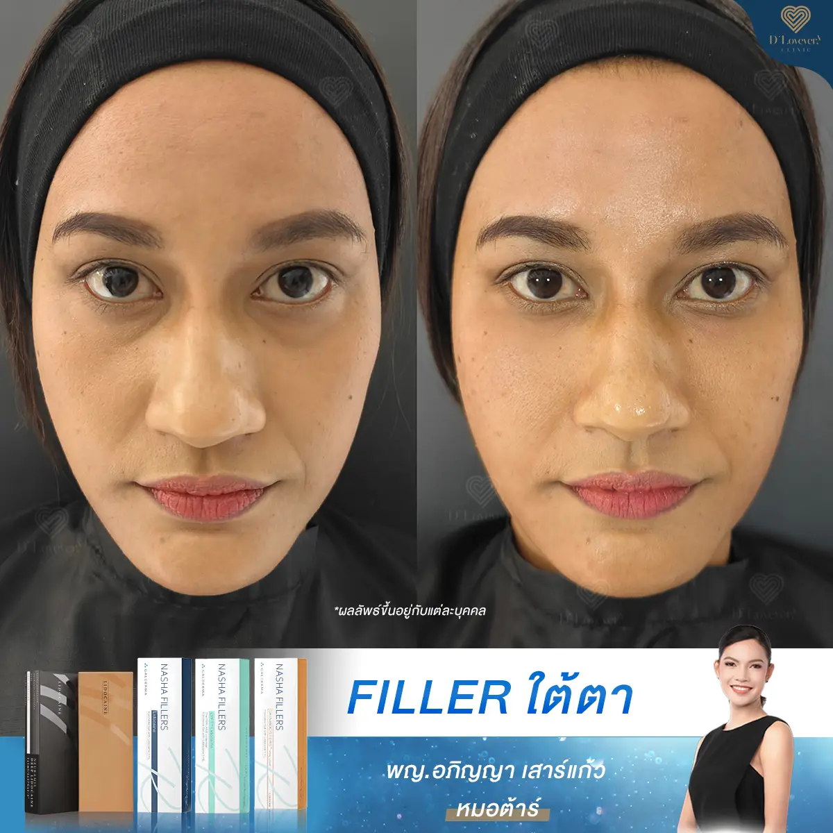 Deep Under Eye Filler Before After