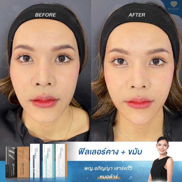 รีวิวฟิลเลอร์คาง อยากหน้าเรียว หมอต้าร์ D' Lovevery clinic_10