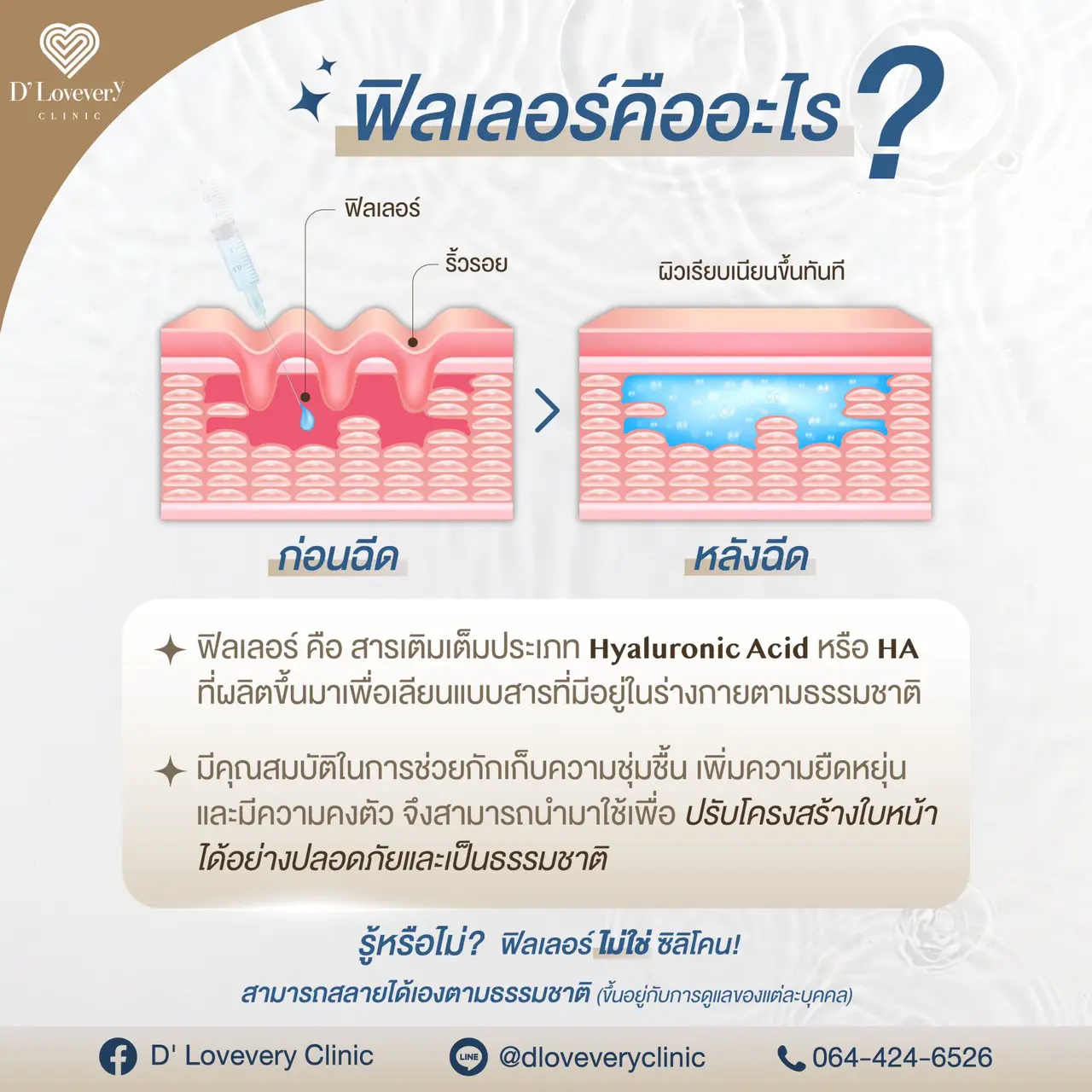 ฟิลเลอร์ คืออะไร อันตรายไหม ฟิลเลอร์ คืออะไร