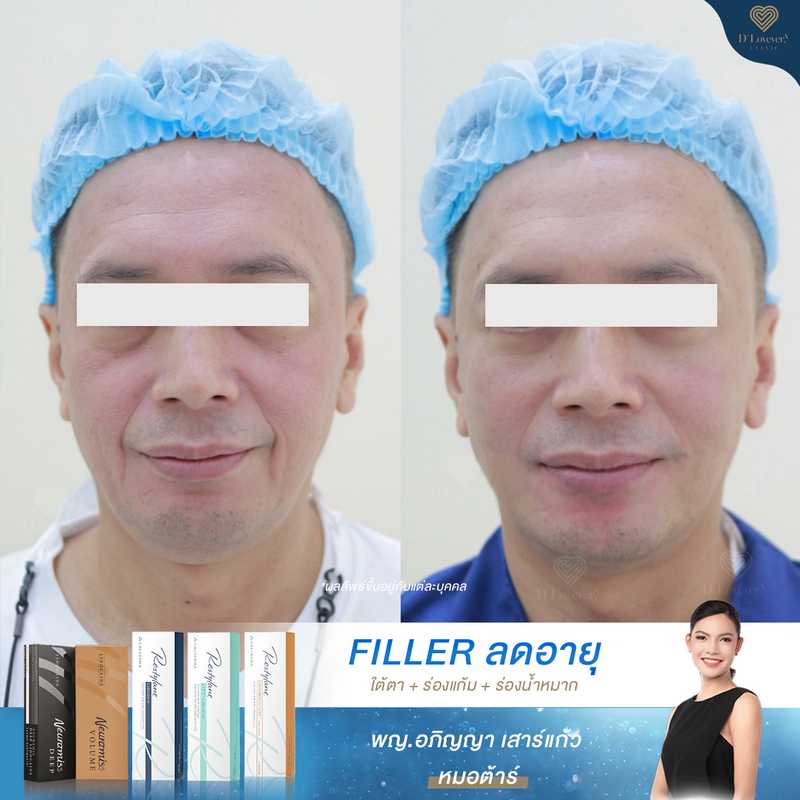 ฟิลเลอร์ใต้ตา