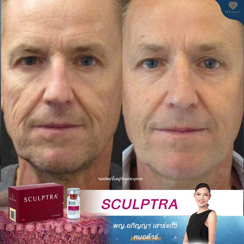 Men Sculptra Before After Review