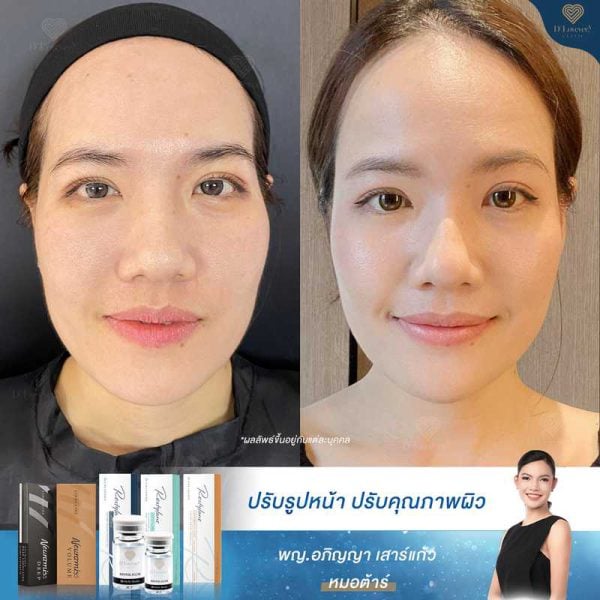 ปรับคุณภาพผิว