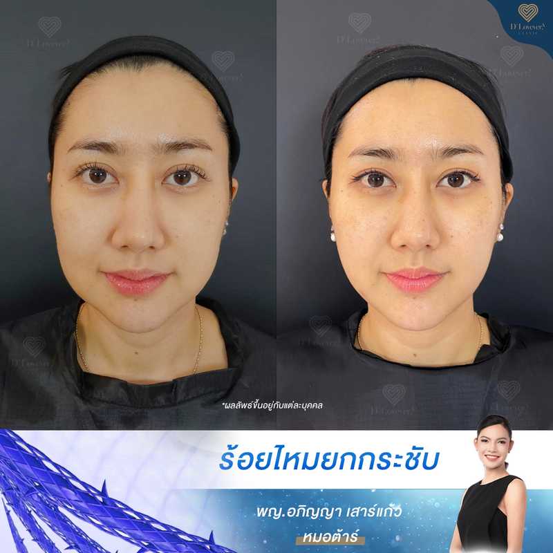 Miss Spy Before After Threadlift Face