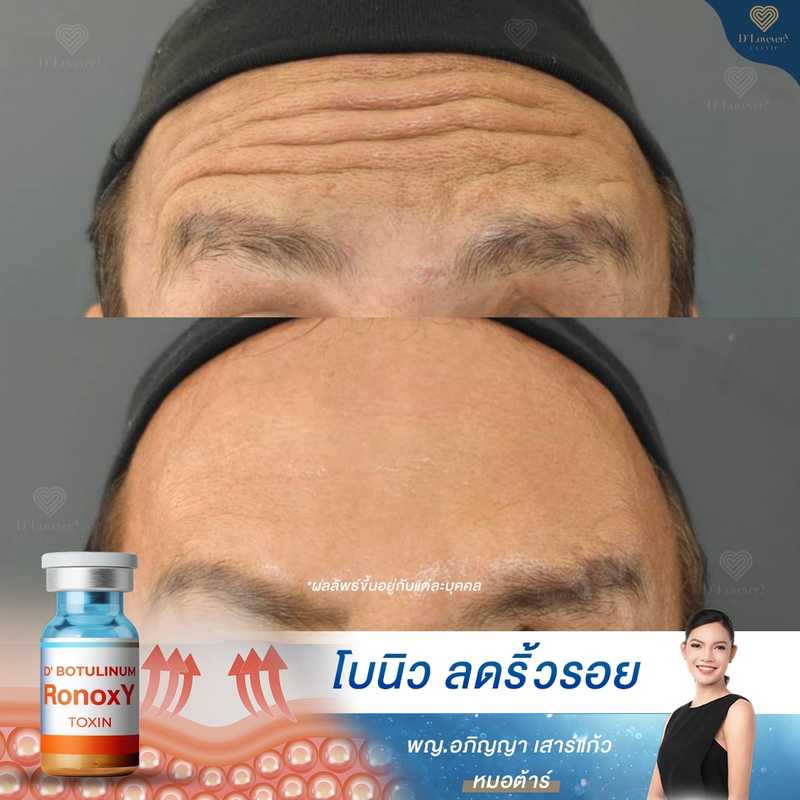 รีวิวโบท็อกซ์ ลดริ้วรอย หมอต้าร์ D' Lovevery clinic_5