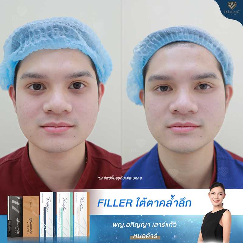 Mr Joe Men Filler Under Eye Before After Clinic