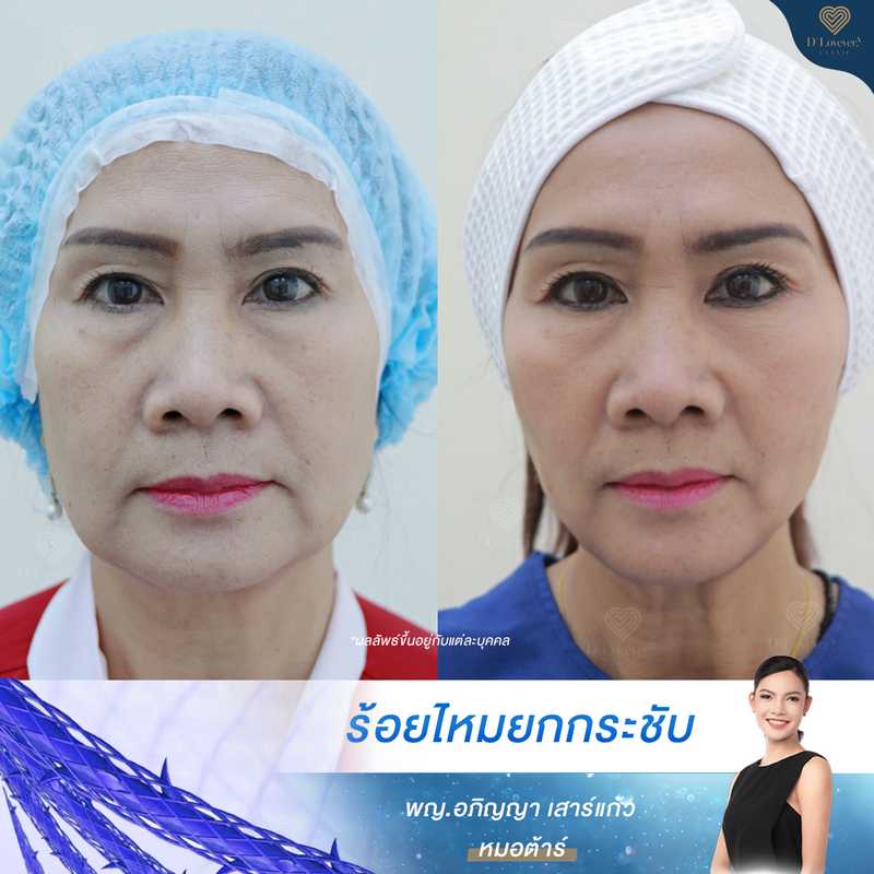 Ms Mon Threadlift Before After D Lovevery