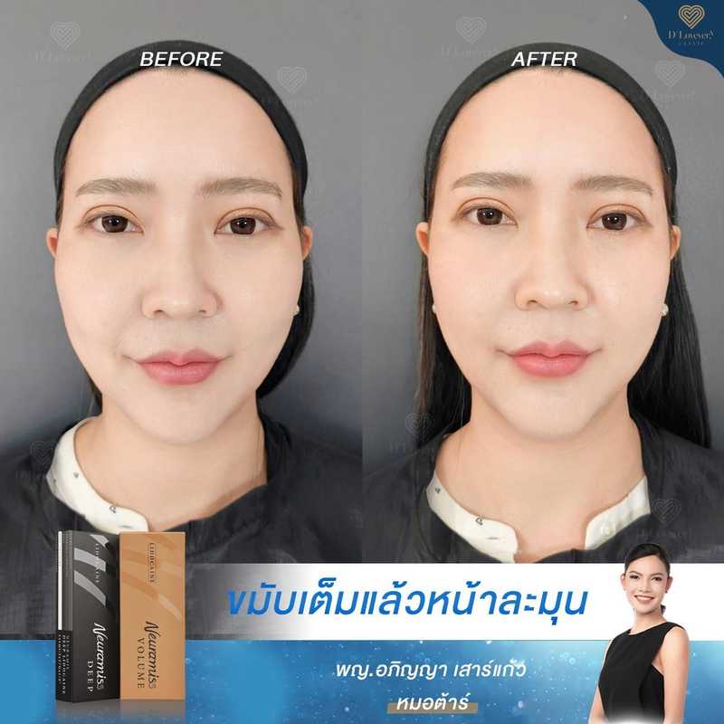 Neuramis Filler Temple Before After