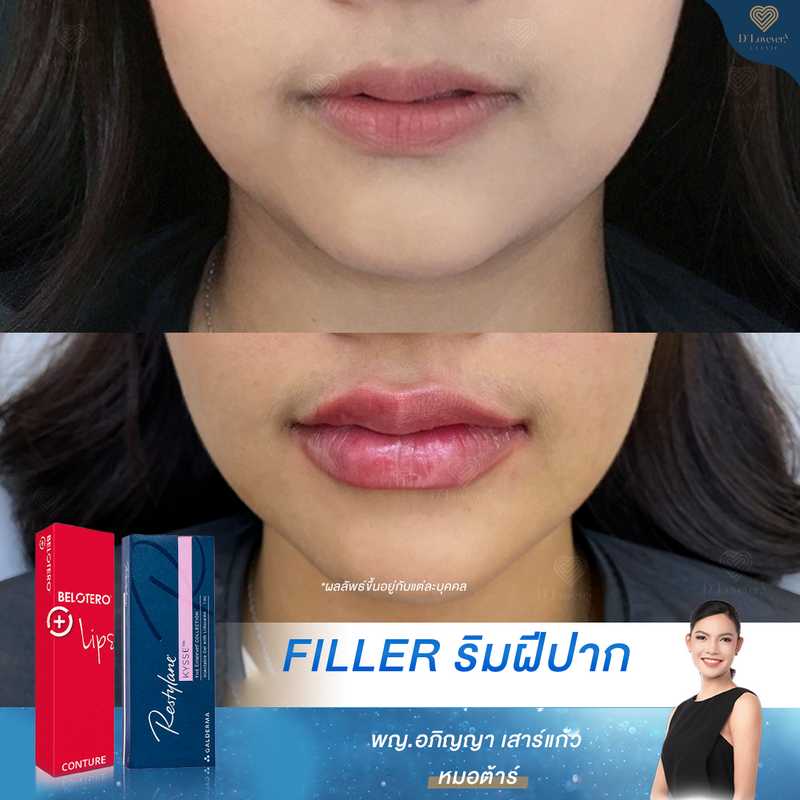 Restylane Kysse Lip Filler Before After