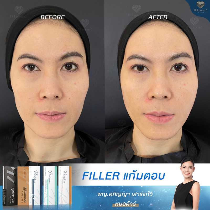 Sunken Cheek Filler Before After